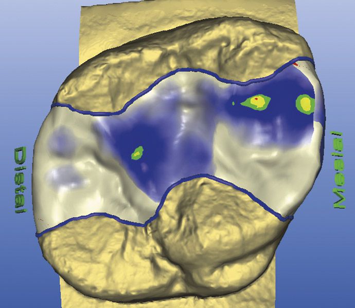 Cerec